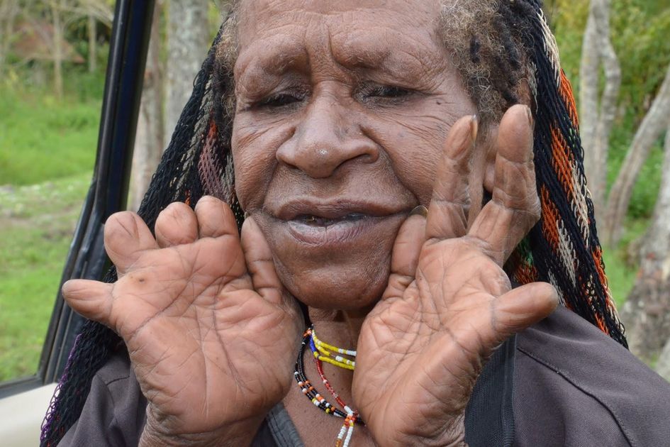 Gambar Iki Palek, Tradisi Potong Jari Dari Papua